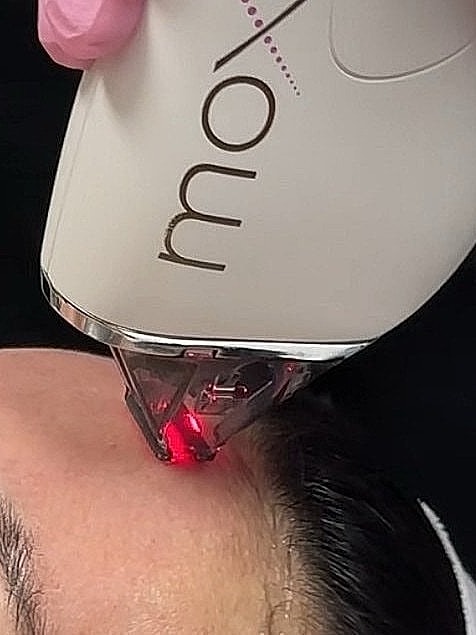 Laser treatment in progress on a client's forehead.