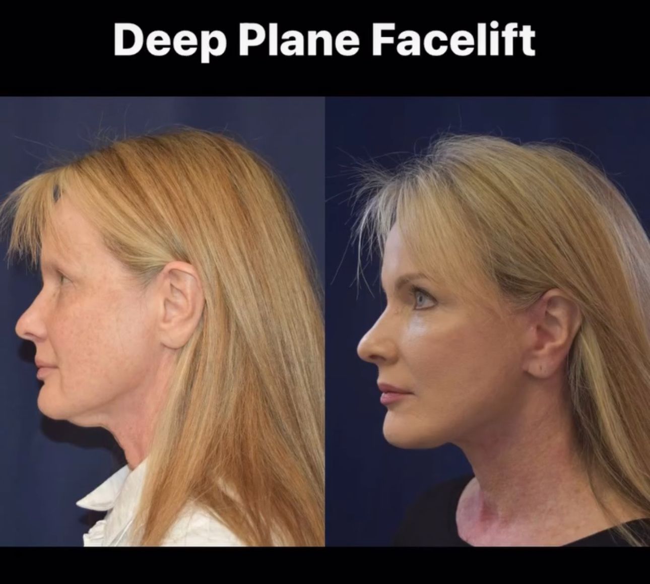 The word facelift can bring up a lot of preconceived notions. We all know that one “overdone celebrity” that had one too many surgeries.  A Deep Plane Facelift provides a soft, natural result that helps you look refreshed while maintaining what makes you you.  This patient is 2 months after a facelift and she looks fantastic. 😊  Have questions? Ask!  Or better yet come see us!  Email: ConsultDutton@charlotteplasticsurgery.com Or Click Link in Bio