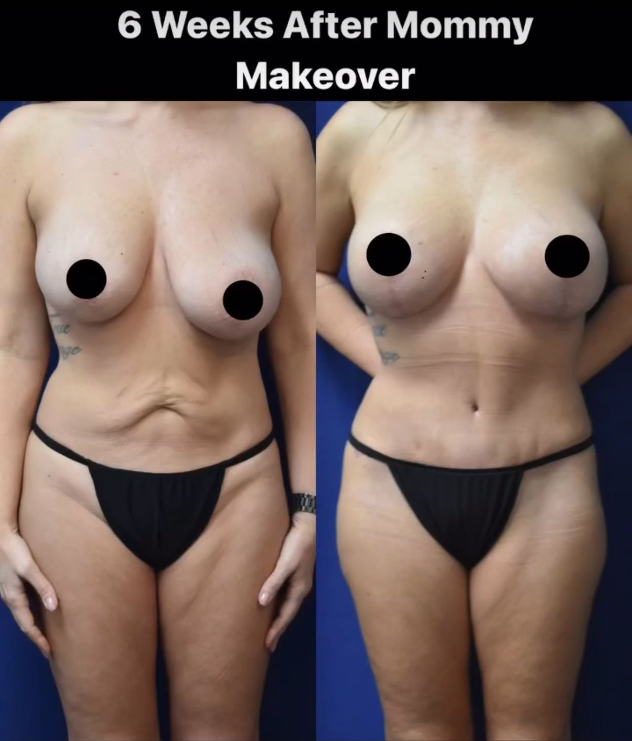 What is a Mommy Makeover? Whatever you want it to be 😊  This patient was 47, and wanted a refresh after children. We performed an implant exchange, breast lift, and tummy tuck.  She’s only 6 weeks out- as the swelling goes down it will continue to get even better! ❤️  Questions? Ask! Or better yet come see us (email or click link above!)