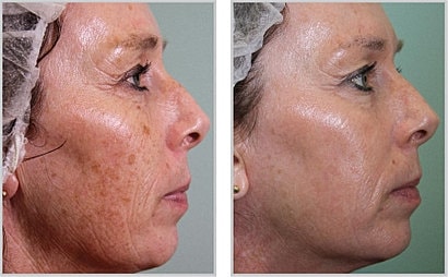 Before and after skin treatment comparison.