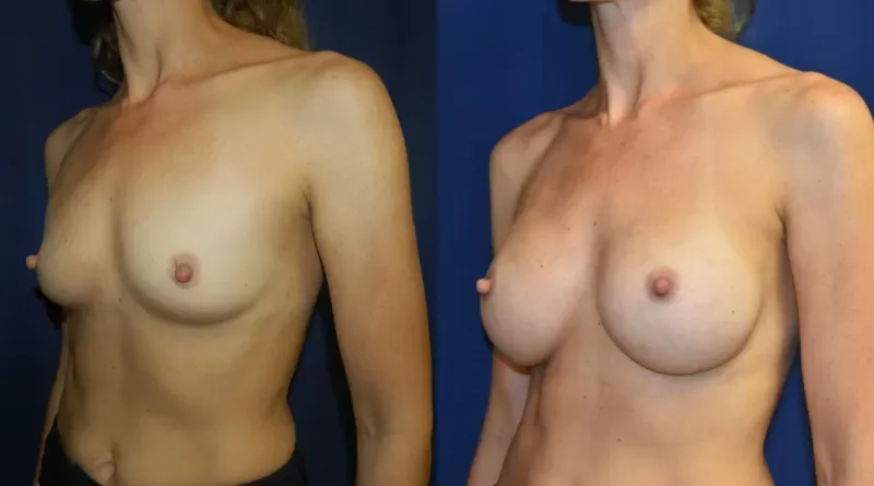 Breast Augmentation Before & After