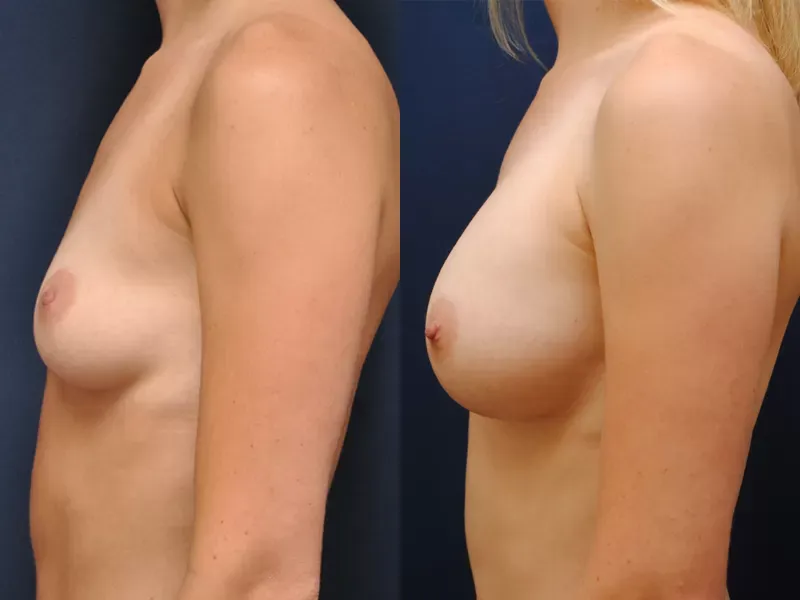 Breast Augmentation Before & After