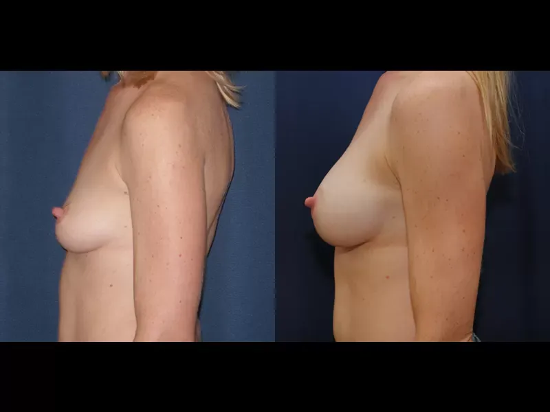 Breast Augmentation Before & After