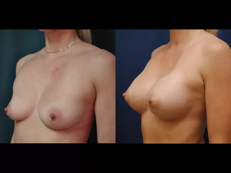 Breast Augmentation Before & After