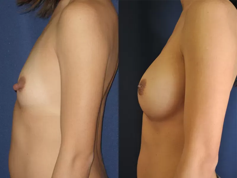 Breast Augmentation Before & After
