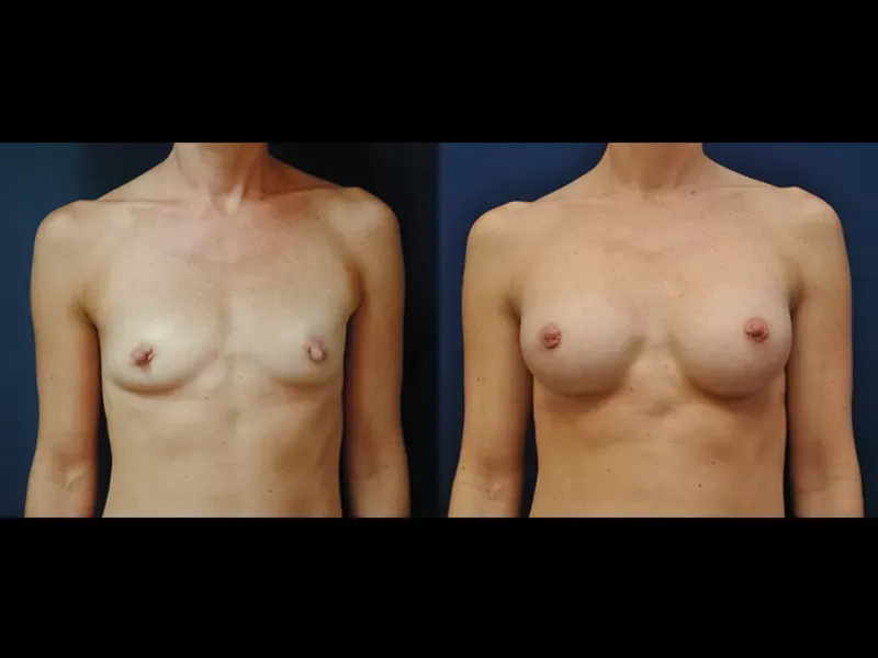 Breast Augmentation Before & After