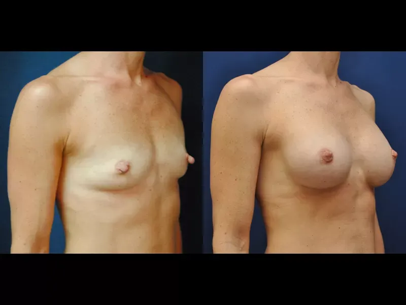 Breast Augmentation Before & After