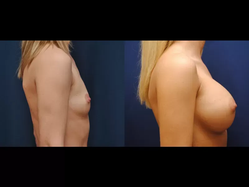Breast Augmentation Before & After