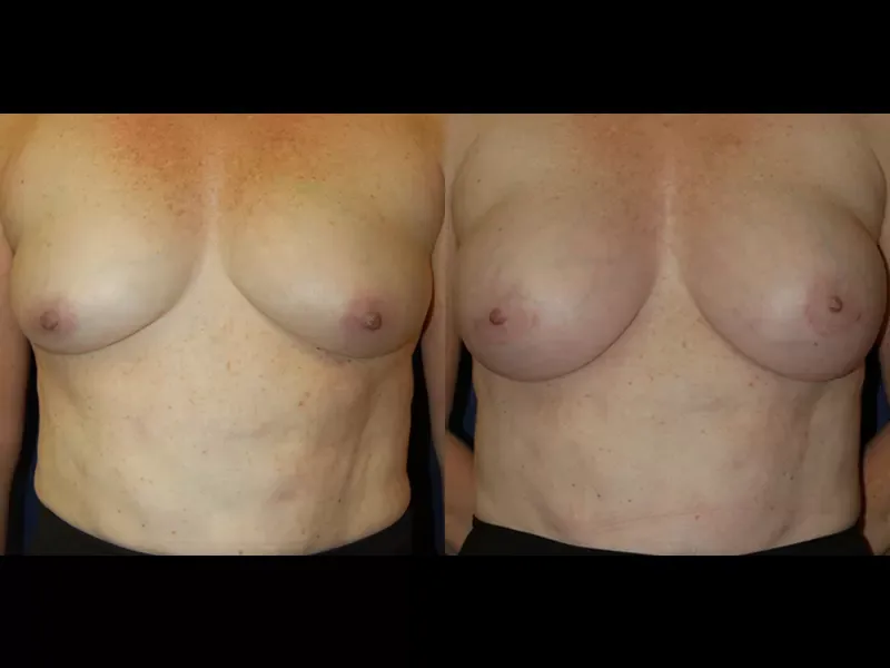 Breast Augmentation Before & After