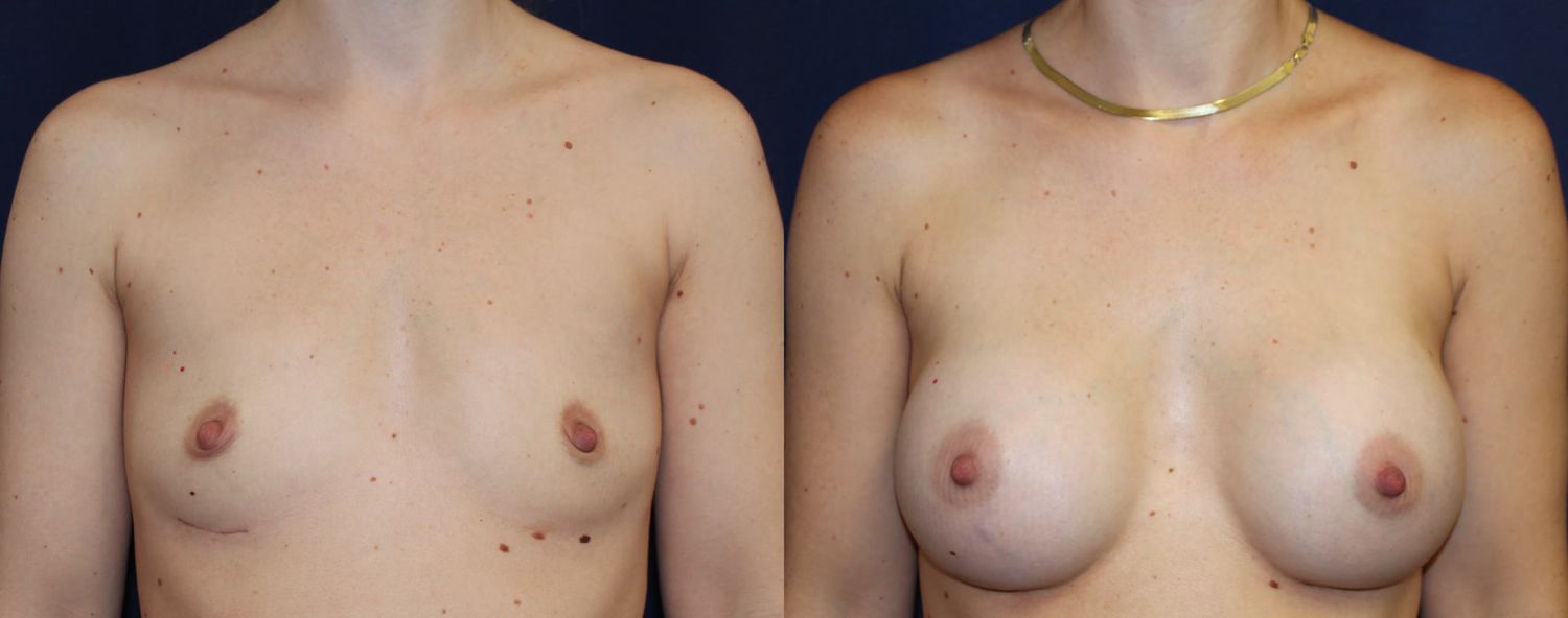 Breast Augmentation Before & After