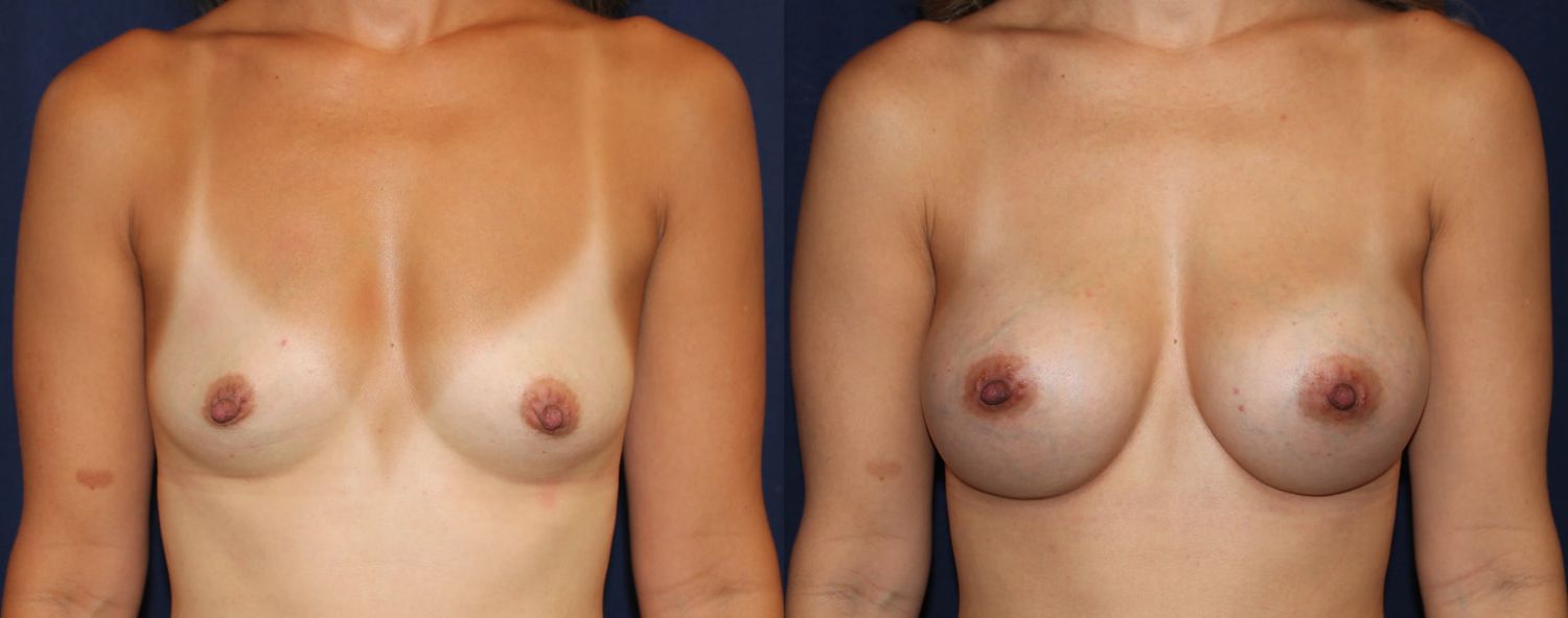 Breast Augmentation Before & After