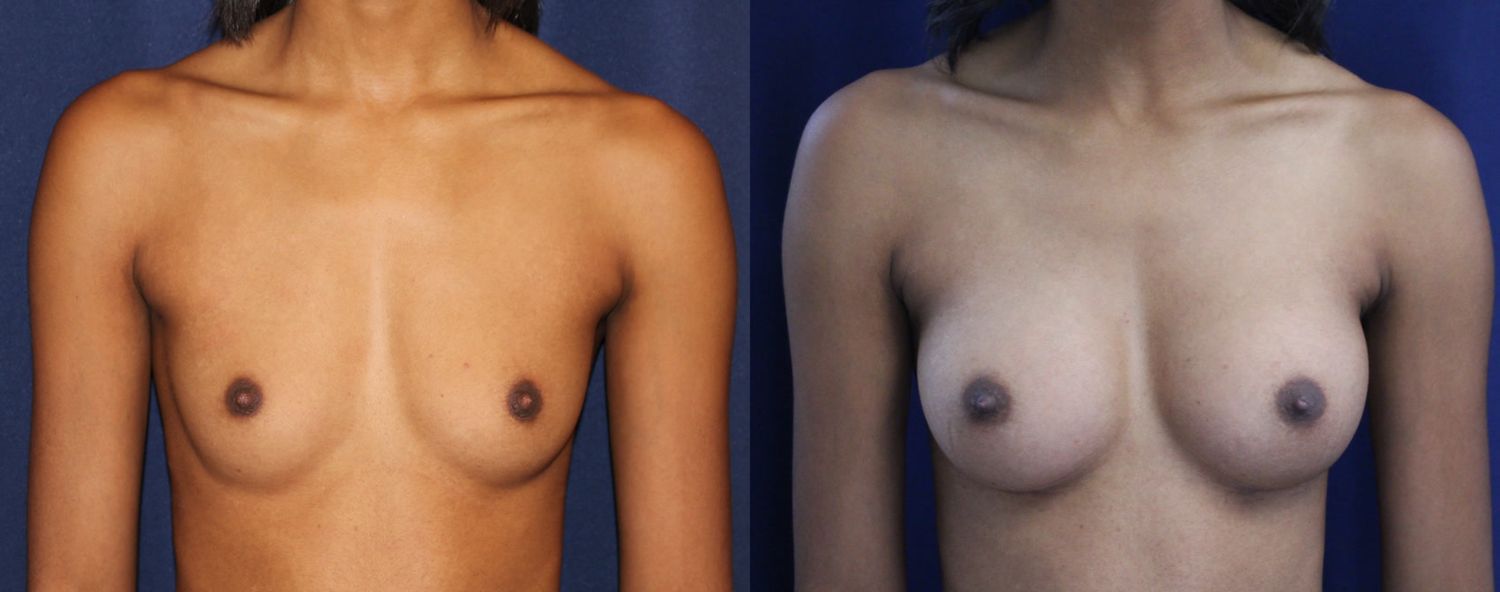 Breast Augmentation Before & After