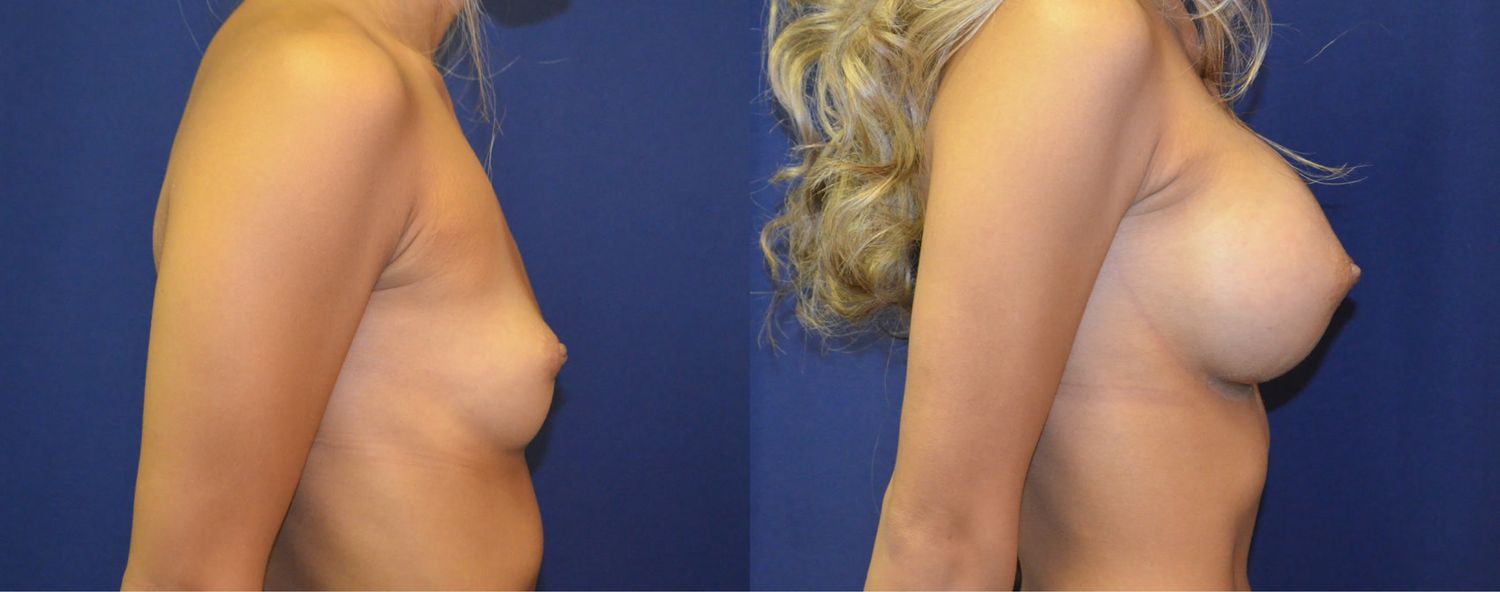 Breast Augmentation Before & After