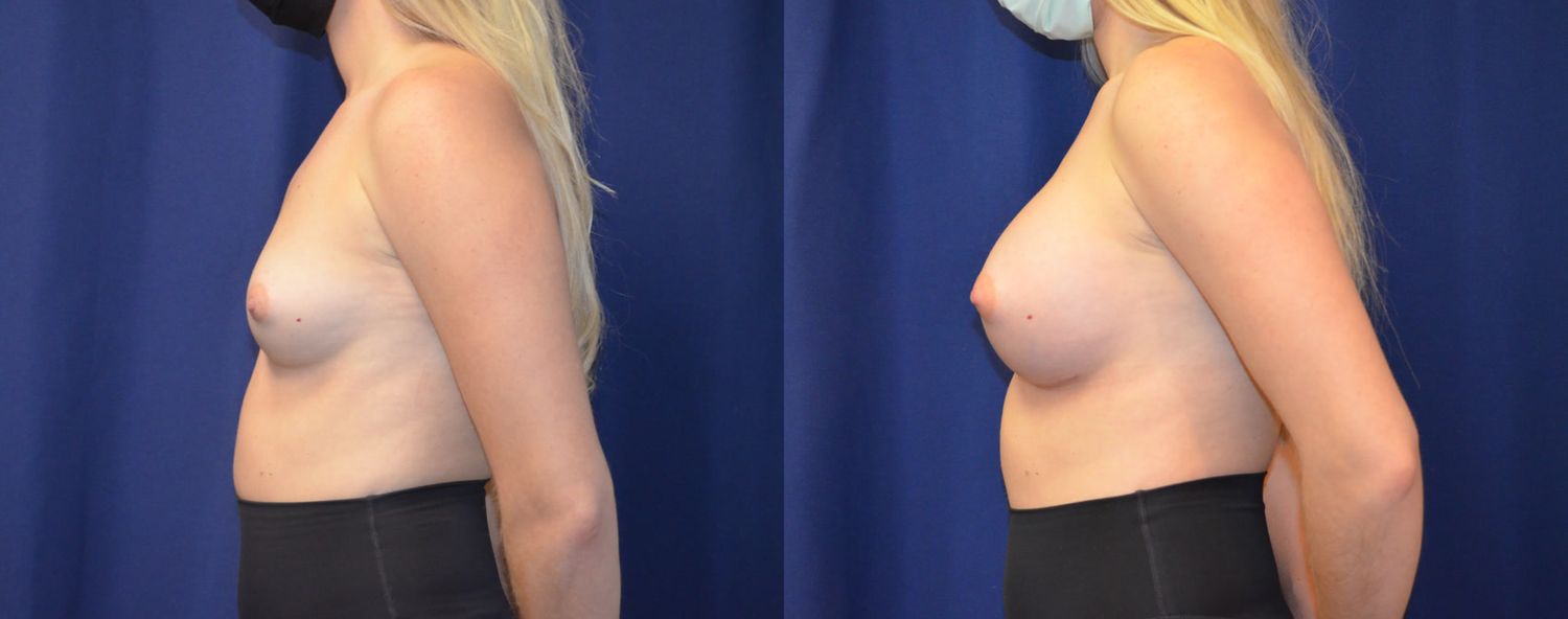 Breast Augmentation Before & After