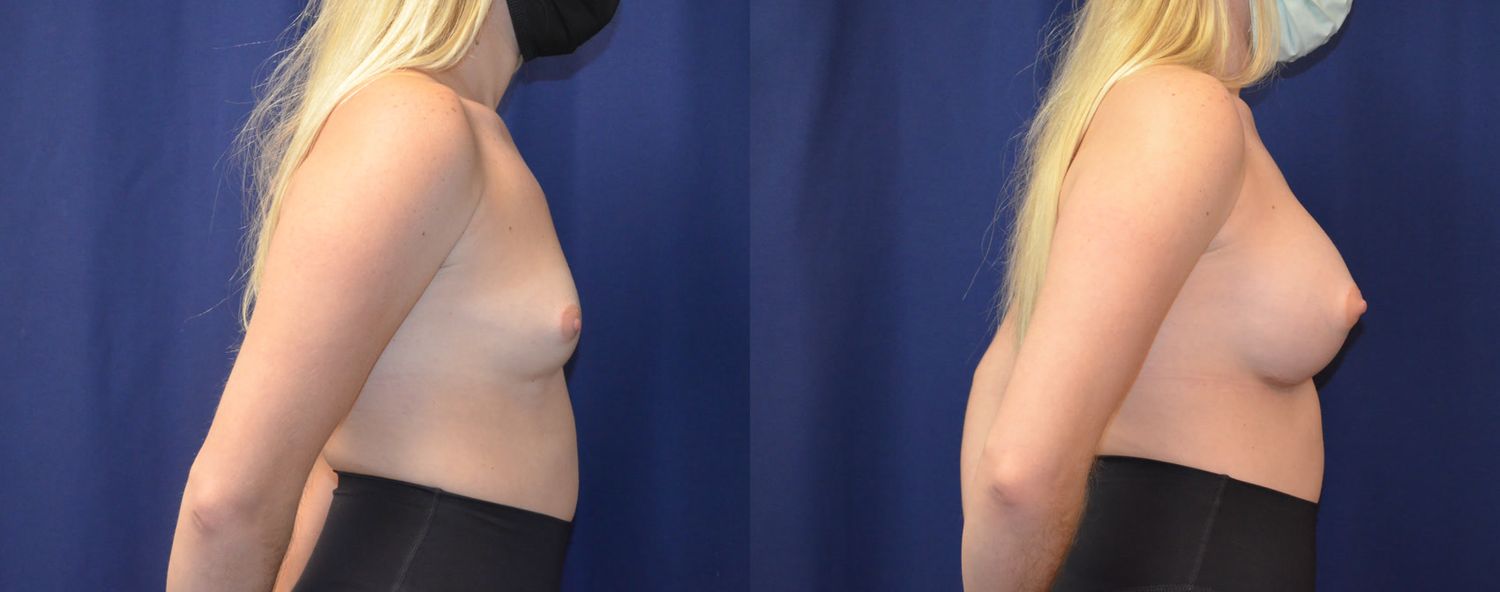 Breast Augmentation Before & After