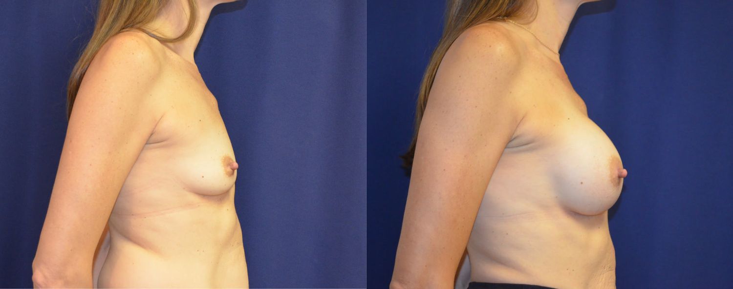 Breast Augmentation Before & After