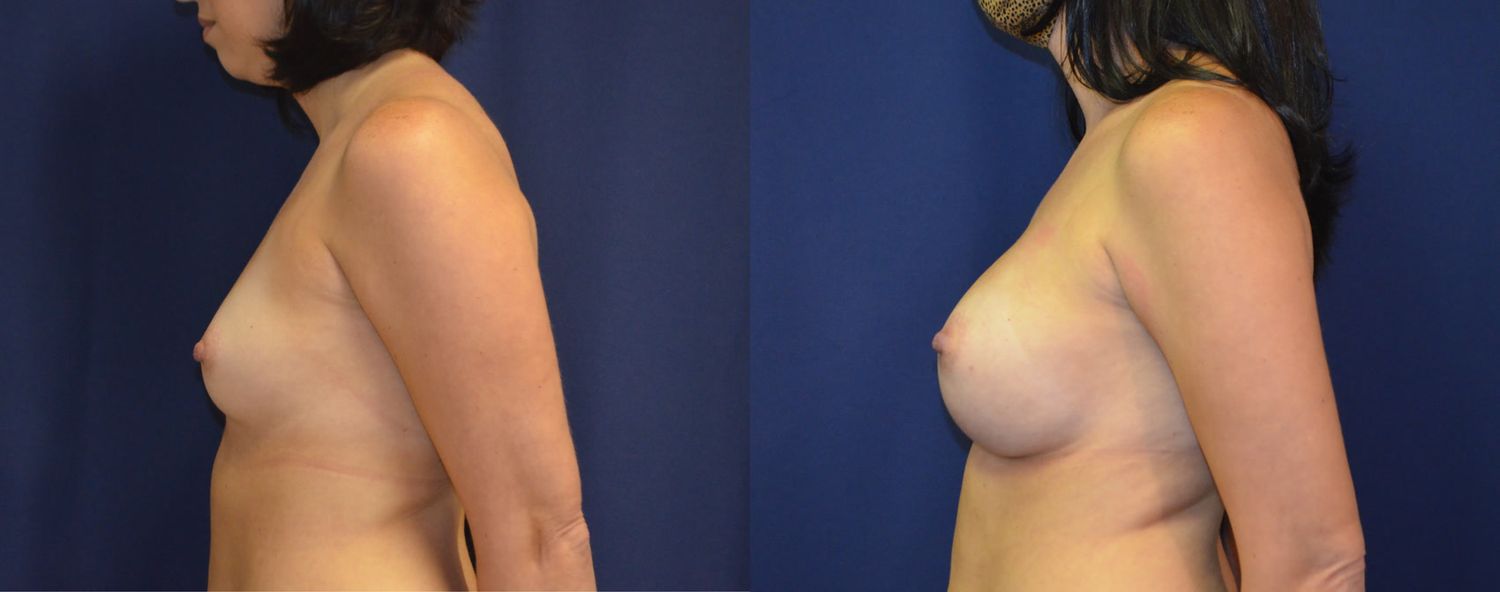 Breast Augmentation Before & After