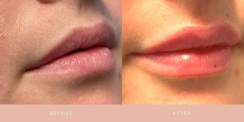 Dermal Fillers Before & After