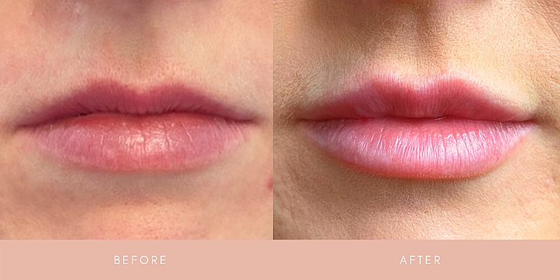 Dermal Fillers Before & After