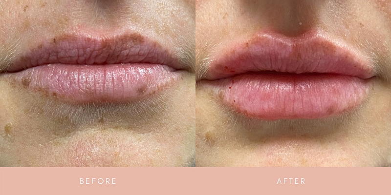 Dermal Fillers Before & After