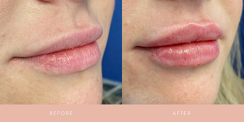 Dermal Fillers Before & After