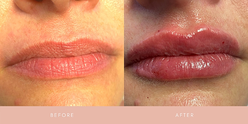 Dermal Fillers Before & After