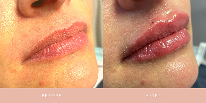Dermal Fillers Before & After
