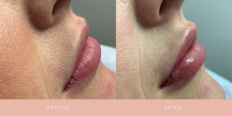 Dermal Fillers Before & After