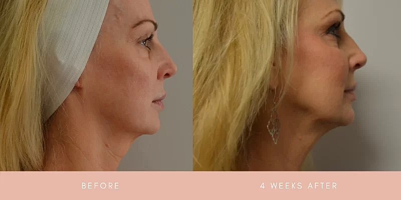 Thread Lift Before & After