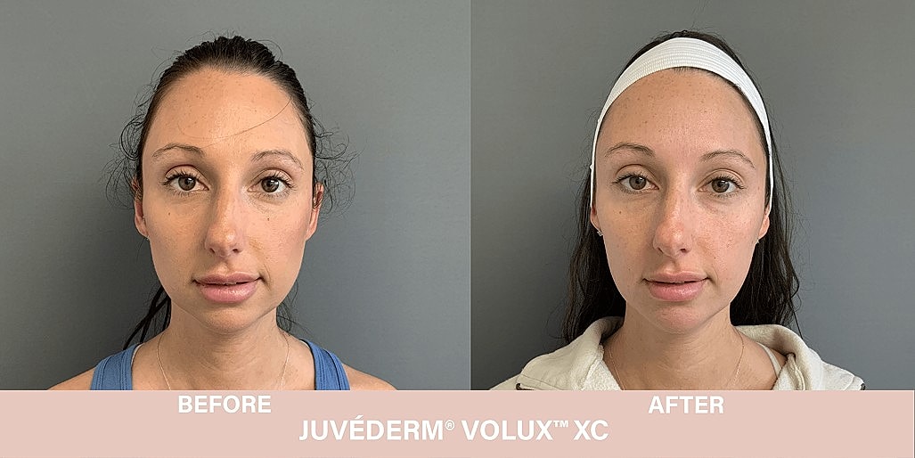 Volux Before & After