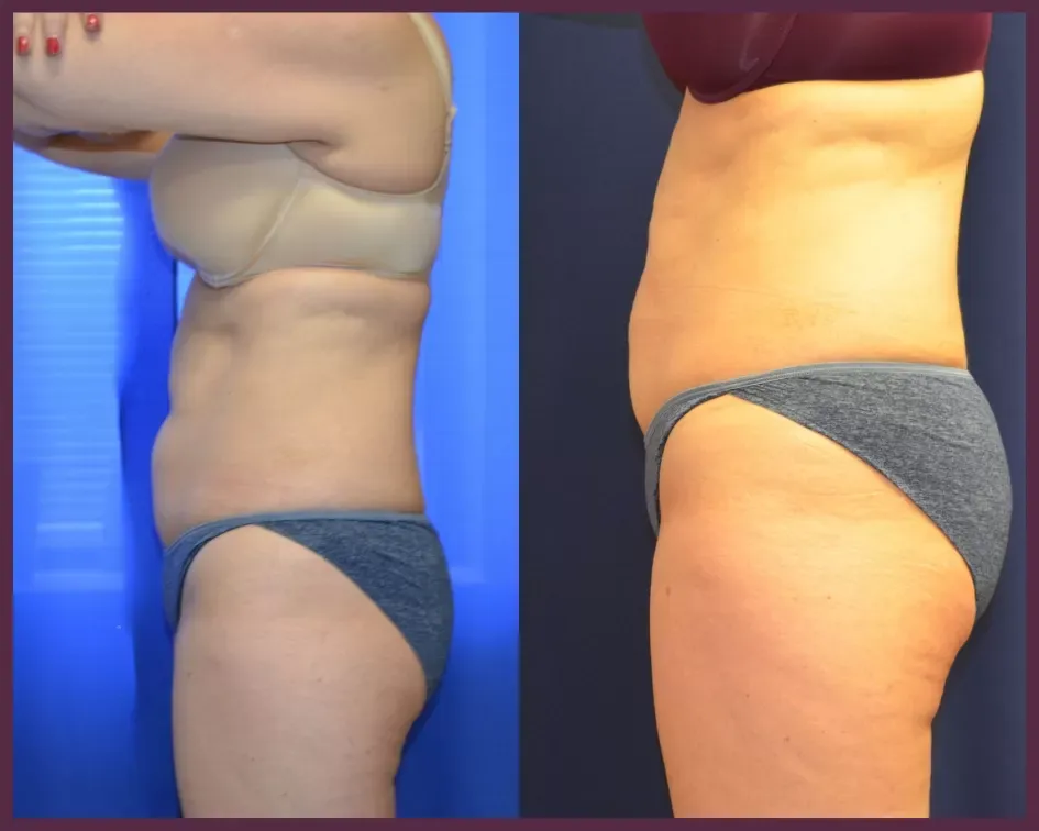 Coolsculpting Before & After