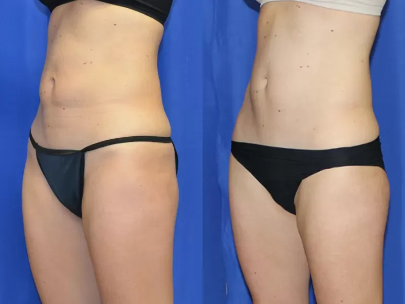 Coolsculpting Before & After