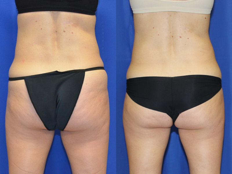 Coolsculpting Before & After
