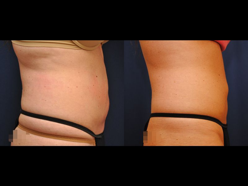 Coolsculpting Before & After
