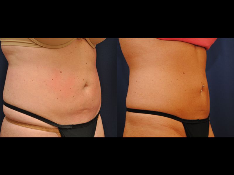 Coolsculpting Before & After