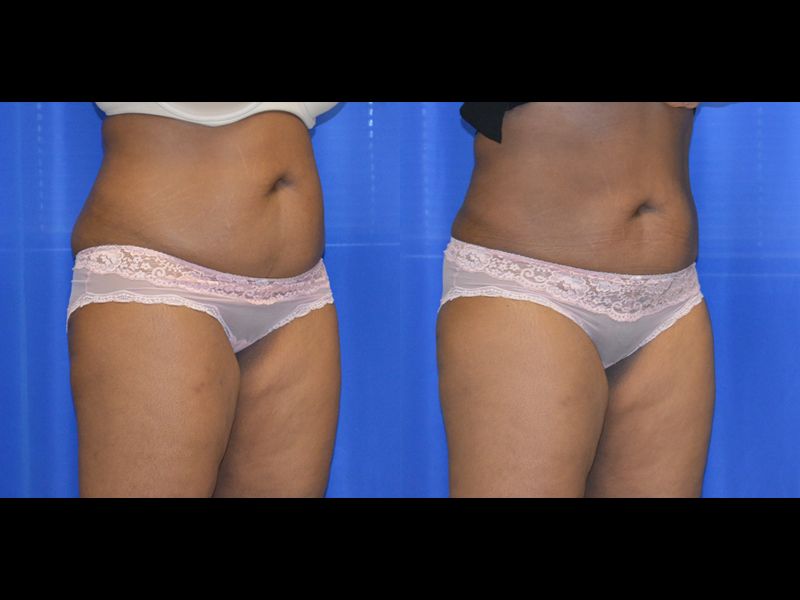 Coolsculpting Before & After