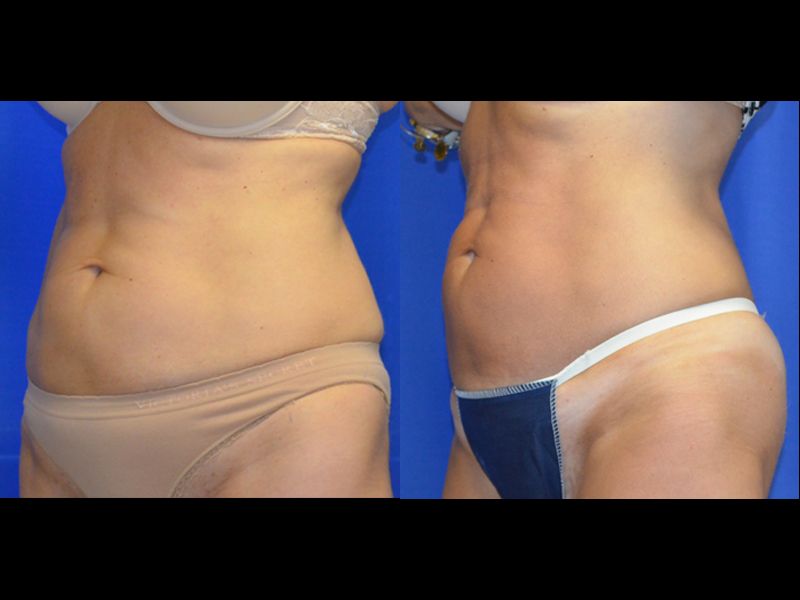 Coolsculpting Before & After