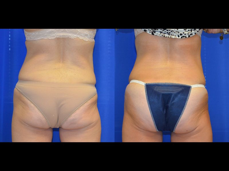 Coolsculpting Before & After