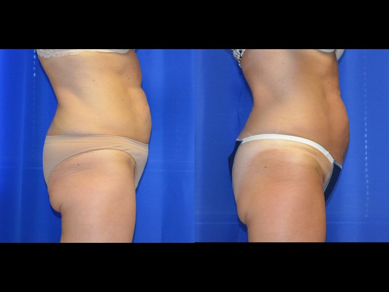 Coolsculpting Before & After