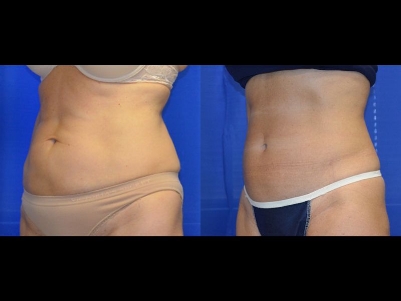 Coolsculpting Before & After