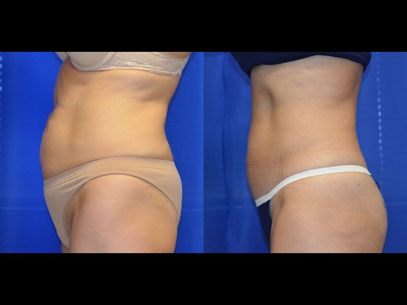 Coolsculpting Before & After