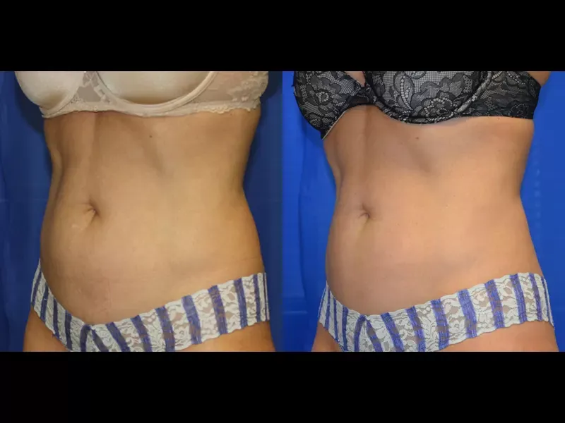 Coolsculpting Before & After