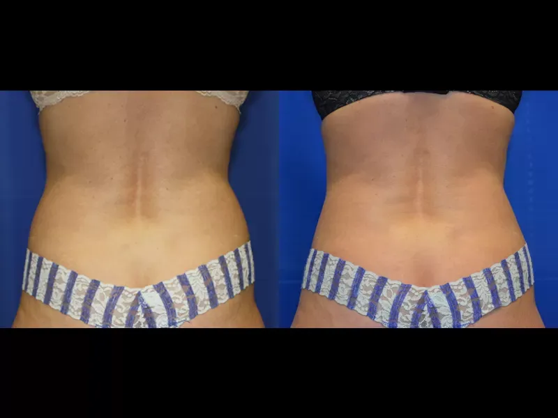 Coolsculpting Before & After