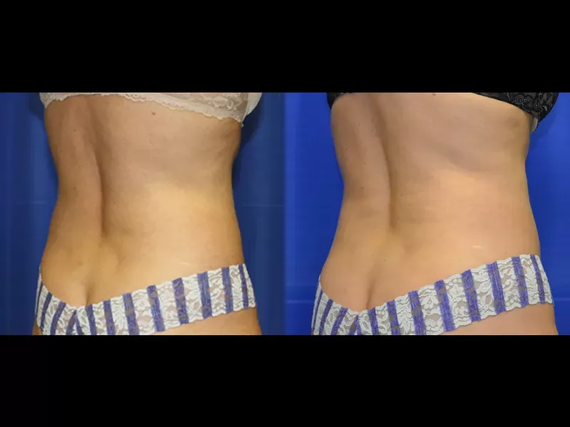 Coolsculpting Before & After