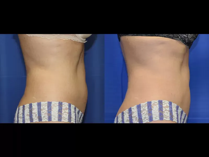 Coolsculpting Before & After