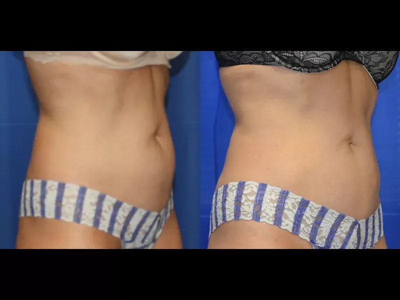 Coolsculpting Before & After