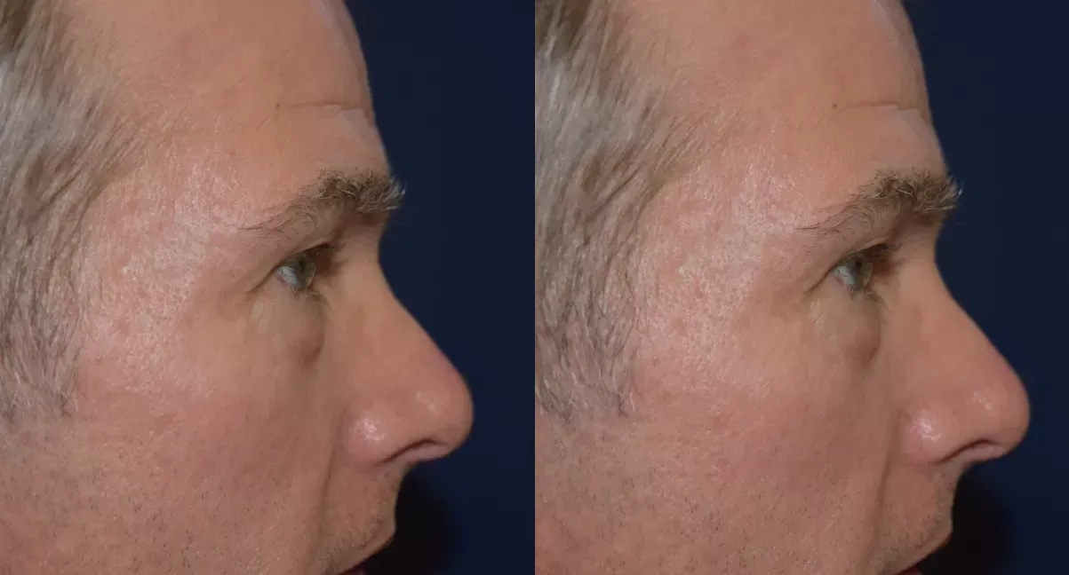 Blepharoplasty Before & After