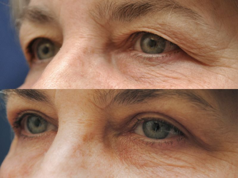 Blepharoplasty Before & After