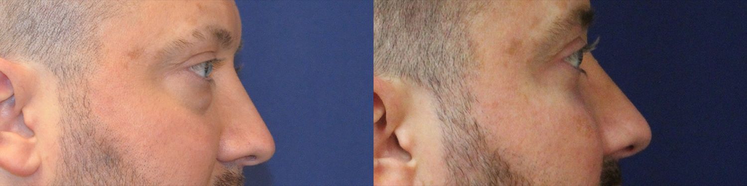 Blepharoplasty Before & After