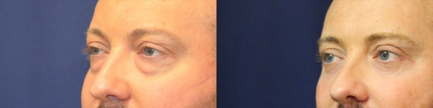 Blepharoplasty Before & After